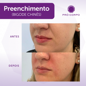 Preenchimento Bigode Chines Fotos  Antes e Depois